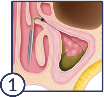 balloon-sinuplasty-1