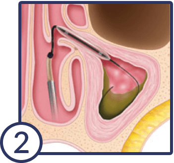 balloon-sinuplasty-2