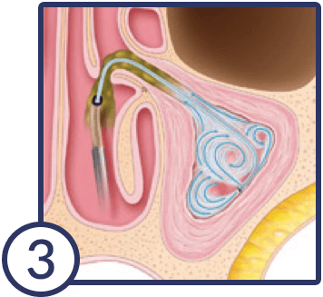 balloon-sinuplasty-3