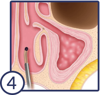 balloon-sinuplasty-4